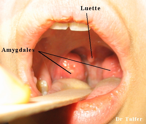Papillomavirus amygdale symptomes. Helmintox suspension buvable
