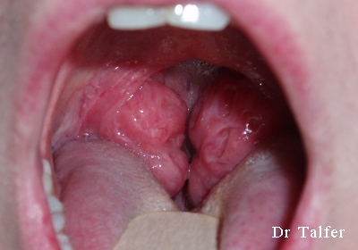 papillomavirus sur amygdale