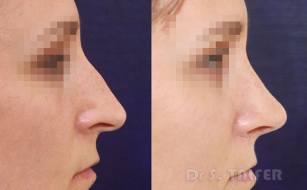 Rhinoplastie à Bordeaux Dr Talfer Chirurgien Esthétique Du Visage